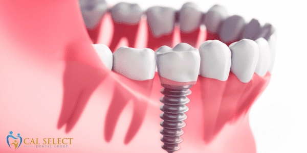 Dental Implants